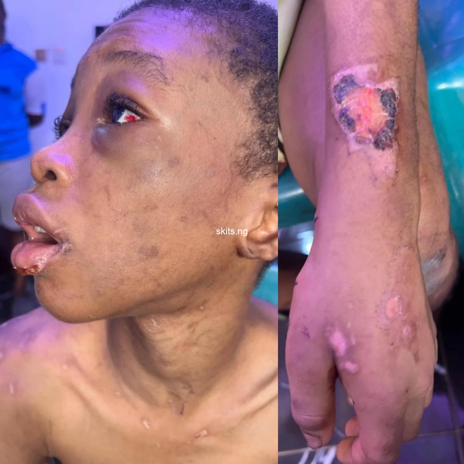 Girl badly beaten burnt and starved by her guardian rescued in lagos photos