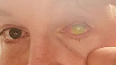 Man used womans placenta to re build his eye and save his sight after acid attack